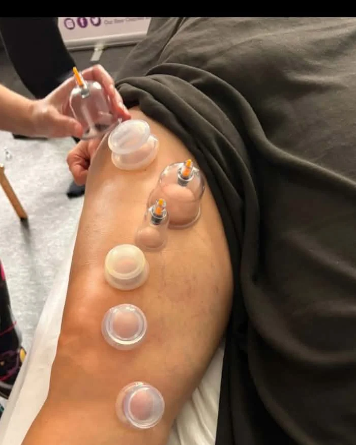 Myofascial cupping — soft suction cups applied along the leg during a treatment